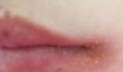 吃白瓜烂嘴角,预防烂嘴角小贴士