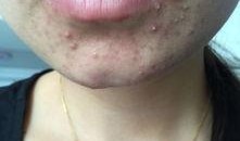 小度痘痘了吃瓜,一场吃瓜引发的美丽蜕变